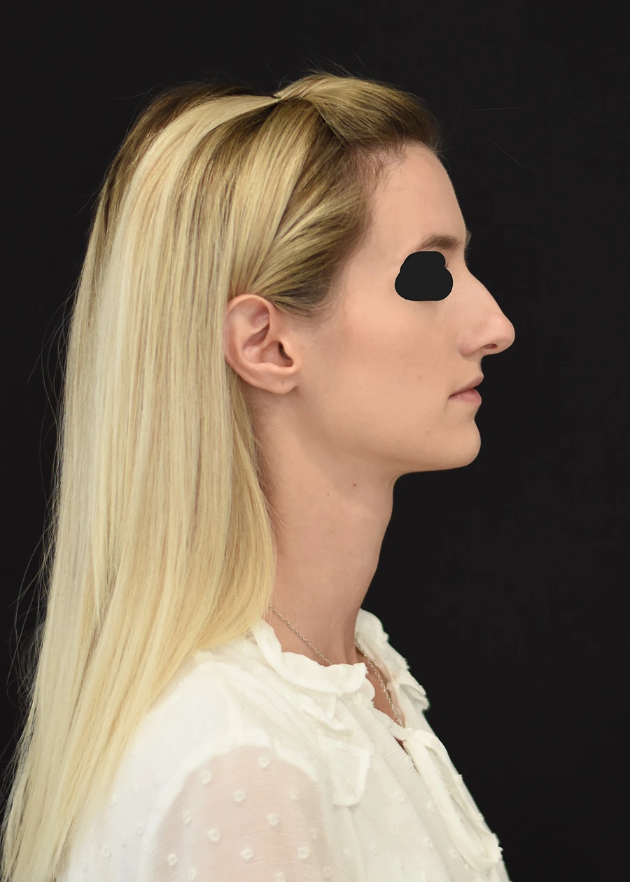 Rhinoplasty Patient 2 Set 2 Before