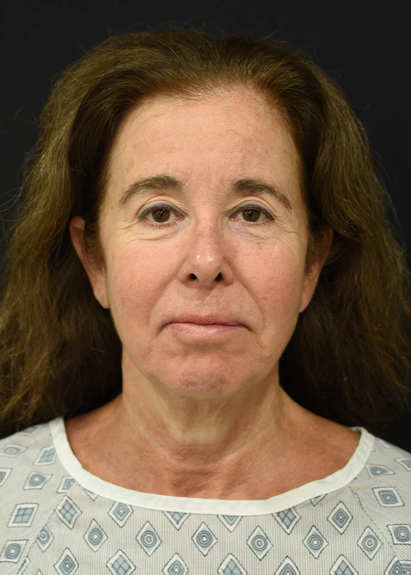 Deep Plane Facelift Patient 20 Set 1 Before